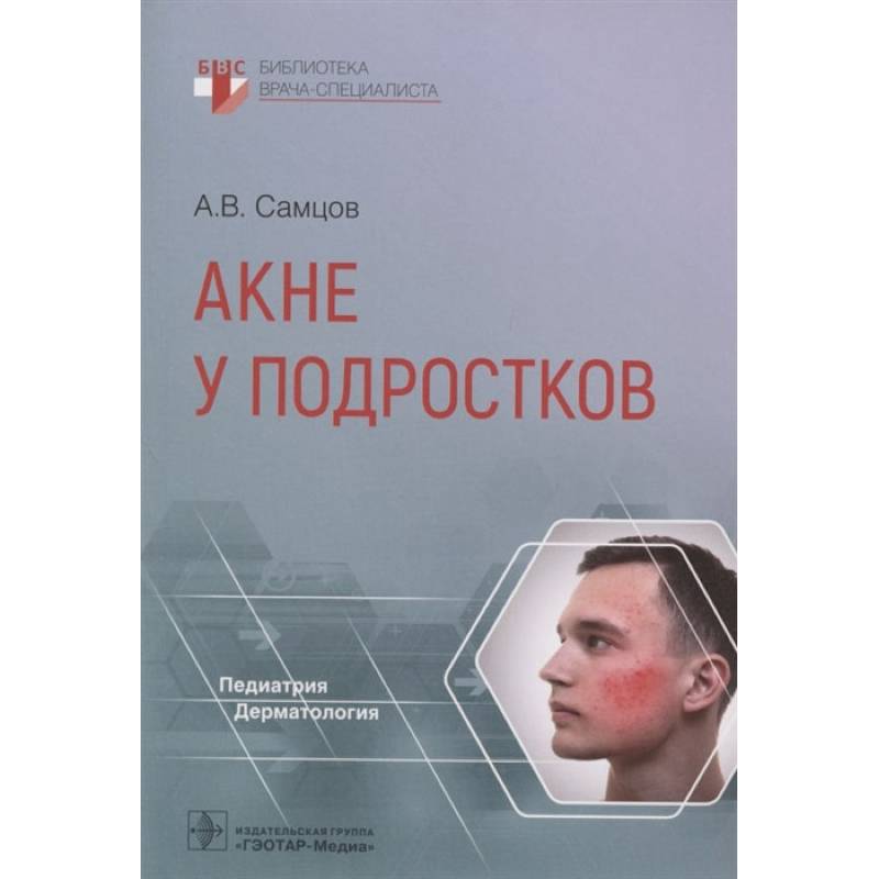 Фото Акне у подростков