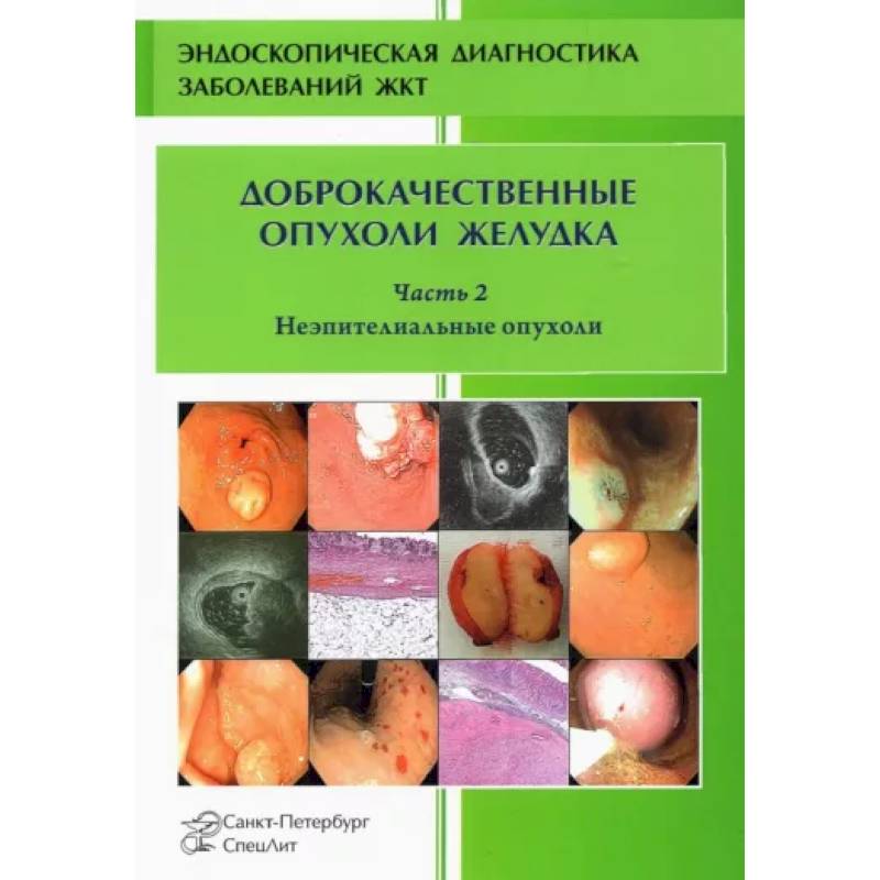 Фото Доброкачественные опухоли желудка. Неэпителиальные  опухоли. Часть 2