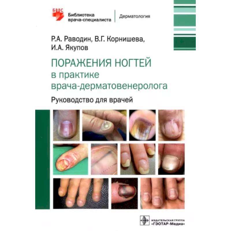 Фото Поражения ногтей в практике врача-дерматовенеролога. Руководство для врачей