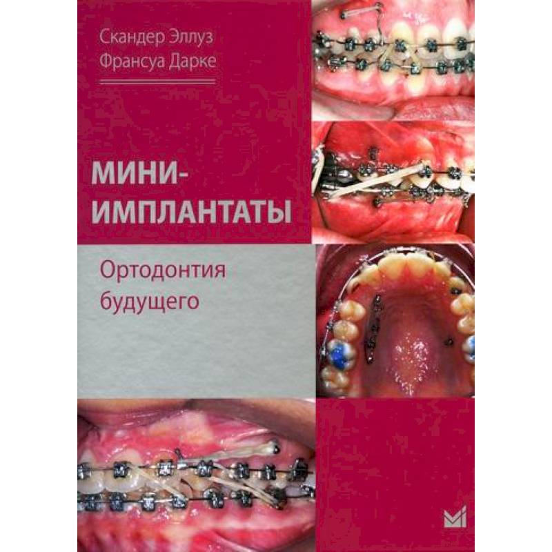 Фото Мини-имплантаты. Ортодонтия будущего