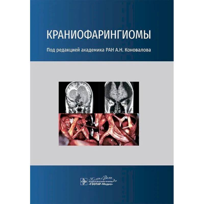 Фото Краниофарингиомы