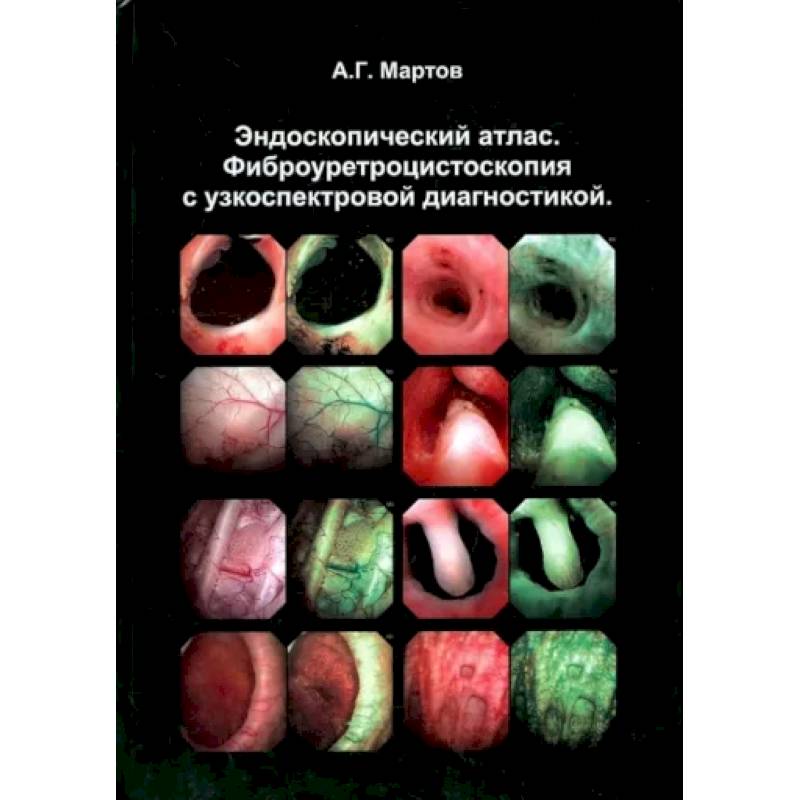 Фото Эндоскопический атлас. Фиброуретроцистоскопия с узкоспектровой диагностикой