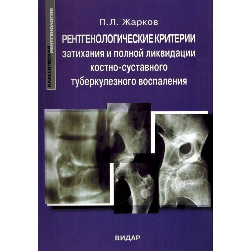 Фото Рентгенологические критерии затихания и полной ликвидации костно-суставного туберкулезного воспаления