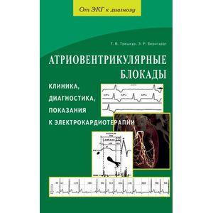 Фото Атриовентрикулярнные блокады. Клиника,диагностика,показания к электрокардиотерапии