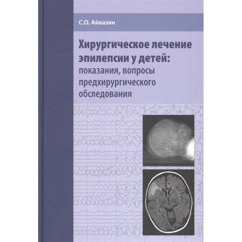 Фото Хирургическое лечение эпилепсии у детей: показания, вопросы предхирургического обследования