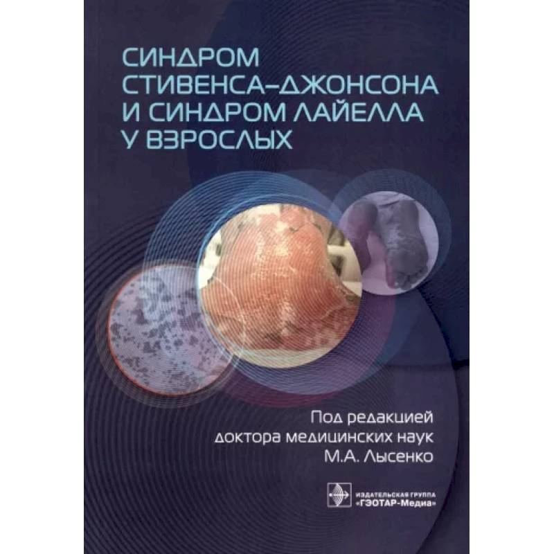 Фото Синдром Стивенса-Джонсона и синдром Лайелла у взрослых