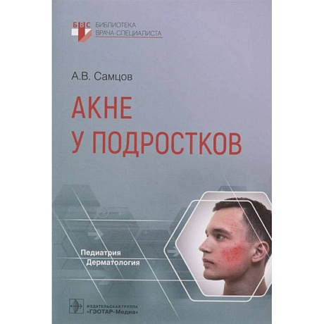 Фото Акне у подростков