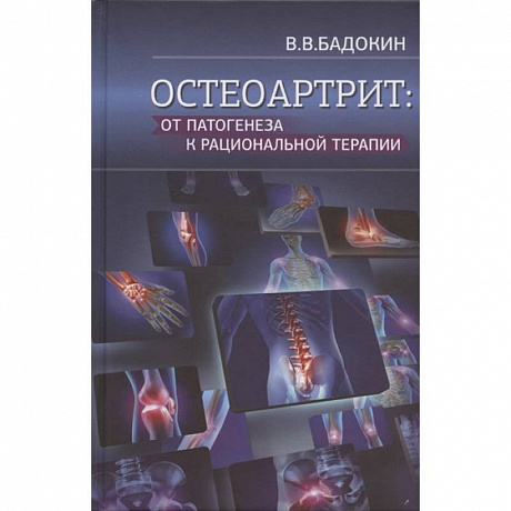 Фото Остеоартрит: от патогенеза к рациональной терапии