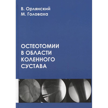 Фото Остеотомии в области коленного сустава