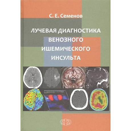 Фото Лучевая диагностика венозного ишемического инсульта