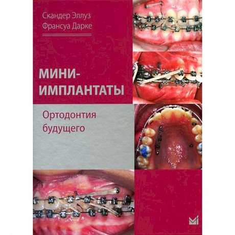 Фото Мини-имплантаты. Ортодонтия будущего