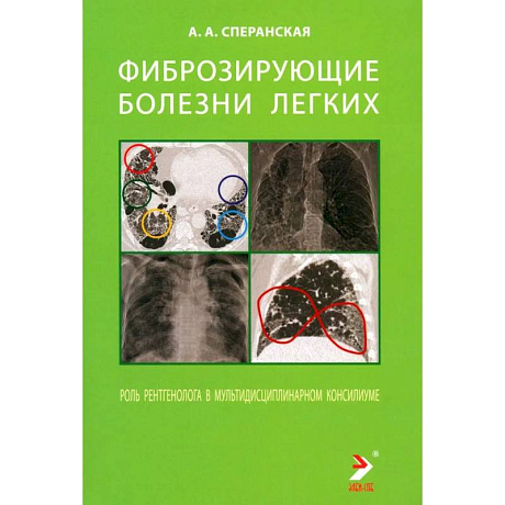 Фото Фиброзирующие болезни легких. Роль рентгенолога в мультидисциплинарном консилиуме