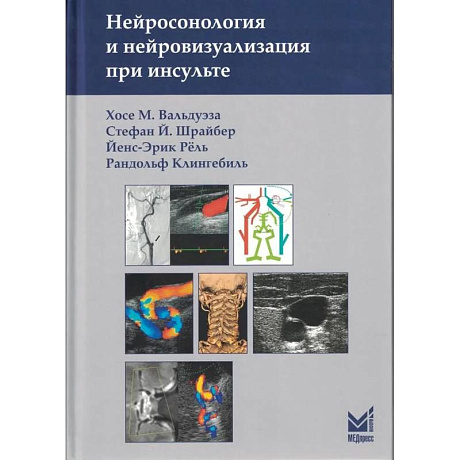 Фото Нейросонология и нейровизуализация при инсульте