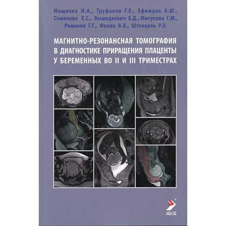 Фото Магнитно-резонансная томография в диагностике приращения плаценты у беременных во II и III триместрах