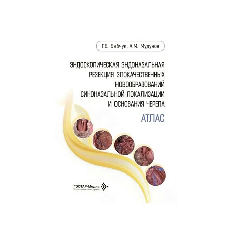 Фото Атлас.Эндоскопическая эндоназальная резекция злокачественных новообразований синоназальной локализации и основания черепа