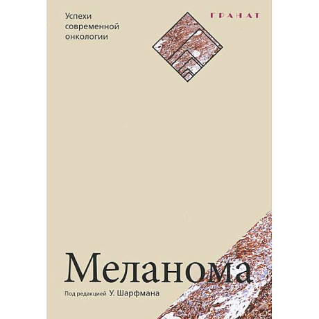Фото Меланома. Успехи современной онкологии