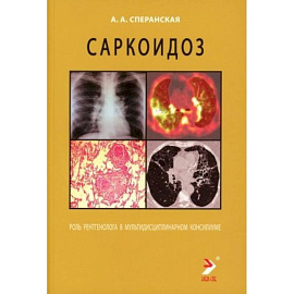 Саркоидоз. Роль ренгенолога в мультидисциплинарном консилиуме